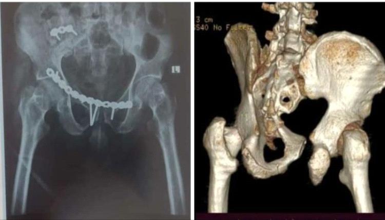 نجاح عملية معقدة لكسور في منطقة الحوض بمستشفى الثورة في تعز