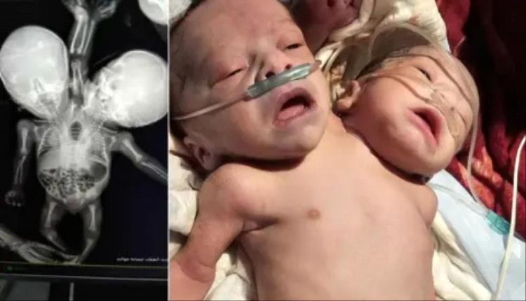 ولادة توأم برأسين منفصلين وجسد ملتصق جنوب صنعاء