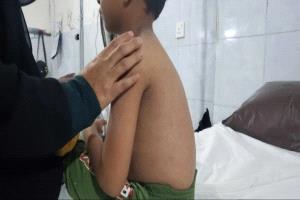 بمناطق الحوثي في تعز.. الحصبة تتفشى في الاطفال ورصد أكثر من 1500 إصابة
