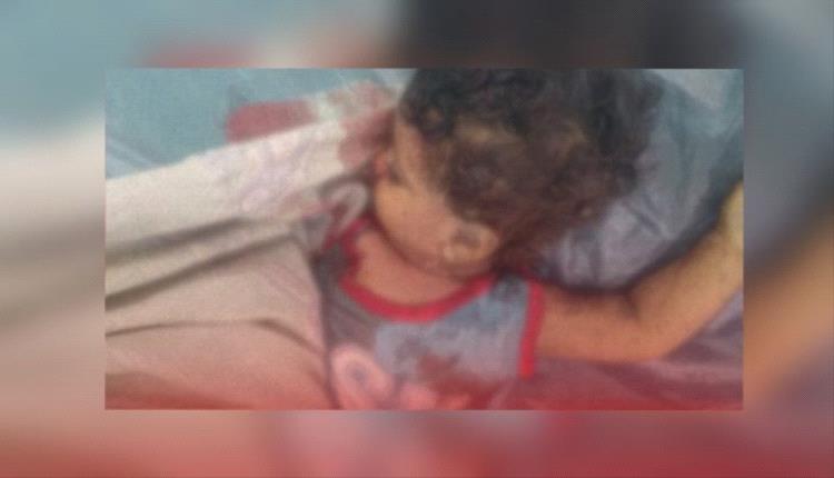 جريمة حوثية بشعة ضحيتها رضيع في تعز.. مزقت رأسه بطيران مسير