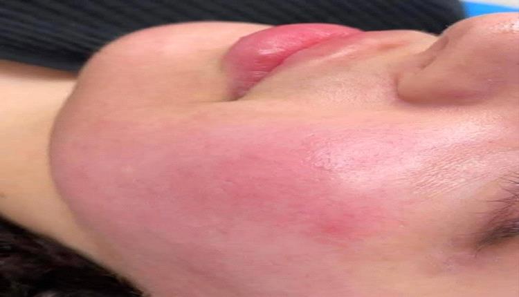 3 نصائح مفيدة لتهدئة البشرة المتهيجة أو الحساسة