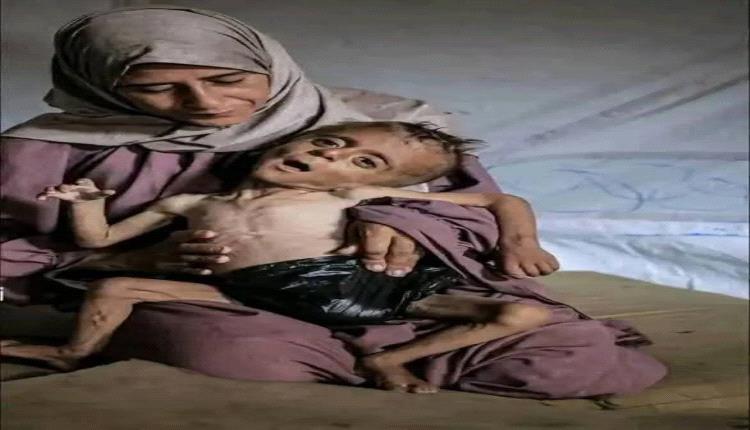 ارتفاع ضحايا التجويع في قطاع غزة إلى 197 وفاة