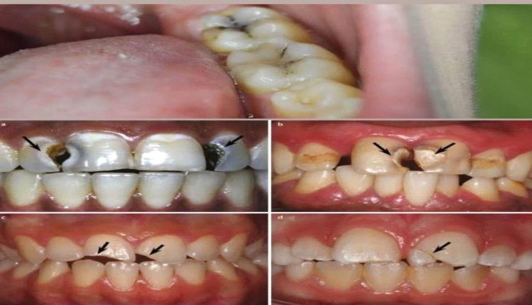 اكتشاف مركب طبيعي يحارب تسوس الأسنان.. ومفاجأة عن الشاي