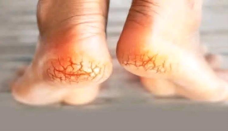 جفاف الكعبين إنذار مبكر لعدوى خطيرة