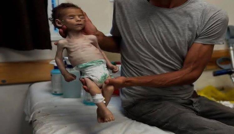 الأول من نوعه في الشرق الأوسط.. الأمم المتحدة تعلن تفشي المجاعة في غزة