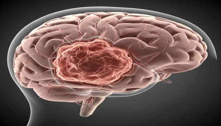 طريقة مطورة لعلاج أحد أخطر أنواع  سرطان الدماغ