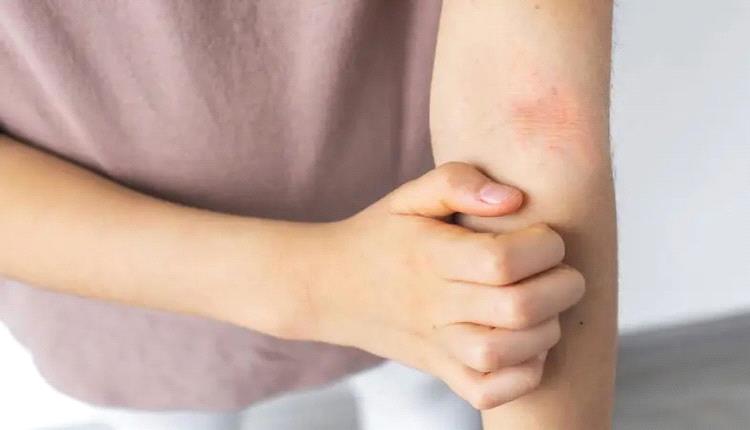 أمراض جلدية تتفاقم في الخريف والشتاء
