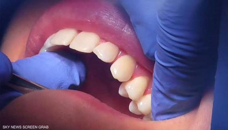 علماء يبتكرون هلاما يحمي الأسنان من التسوس 