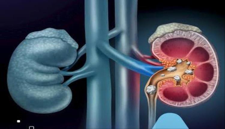 5 مشروبات تقلل خطر حصوات الكلى بنسبة كبيرة