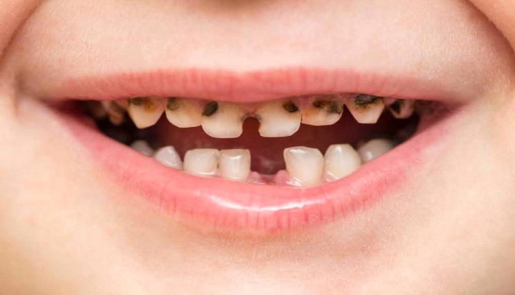 هذا الفيتامين يقلل خطر تسوس أسنان الأطفال