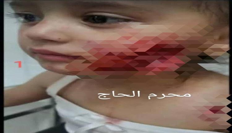 غضب عارم في تعز بعد نهش كلب مسعور وجه طفلة في الروضة