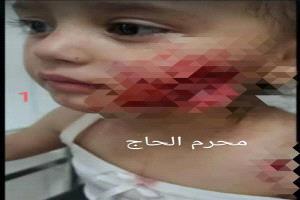 غضب عارم في تعز بعد نهش كلب مسعور وجه طفلة في الروضة