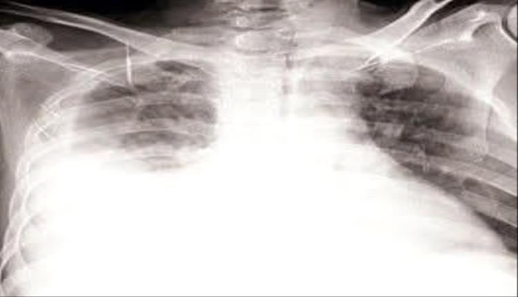 د. وهاج المقطري يكشف إصابة شاب بالسل الجنبي في صنعاء رغم سلبية كل الفحوصات