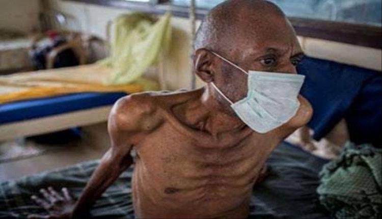 مرض معدي يسبب وفاة أكثر من مليون شخص حول العالم