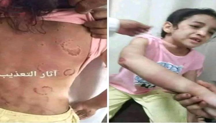 زوجة أب تُعذّب طفلة الثمانية أعوام حتى كسرت أضلاعها لأنها لم تنظف المطبخ