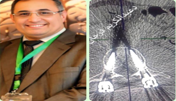 الجرّاح الشرعبي: لسنا بحاجة لرفع مسامير العمود الفقري إلا في حالة القيح