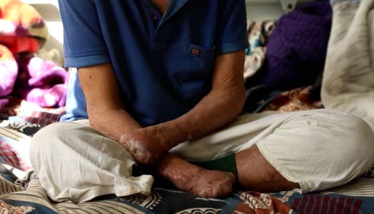 آلاف المصابين بالجذام في اليمن يواجهون الموت والنبذ