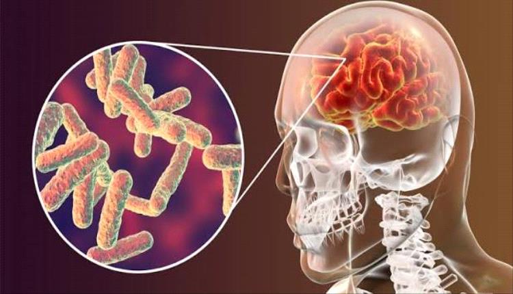 تحذير طبي عاجل من صنعاء يكشف أخطر مؤشرات الحمى الشوكية
