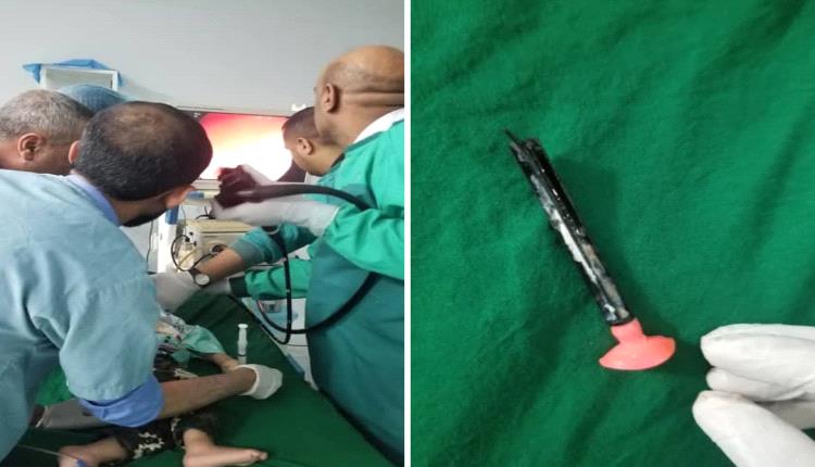 عملية تنقذ طفل في صنعاء.. استخراج جسم غريب ظل 14 يوم داخل معدته