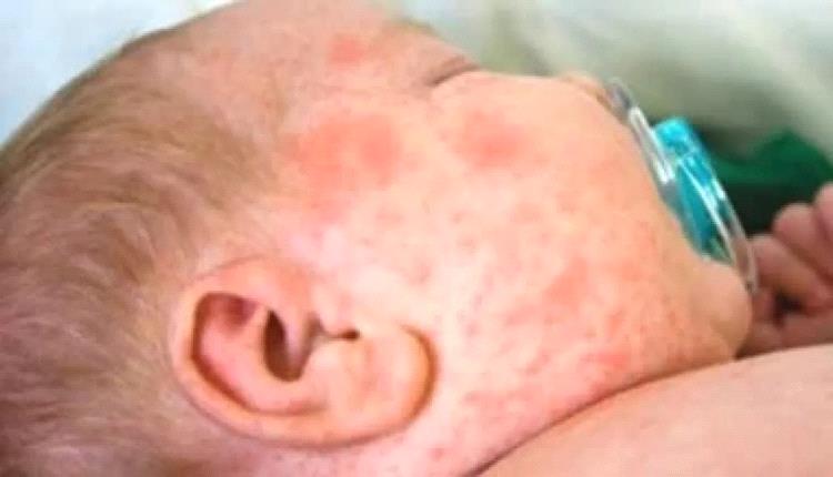 الحصبة يعاود الانتشار في حضرموت رغم خملات التطعيم 