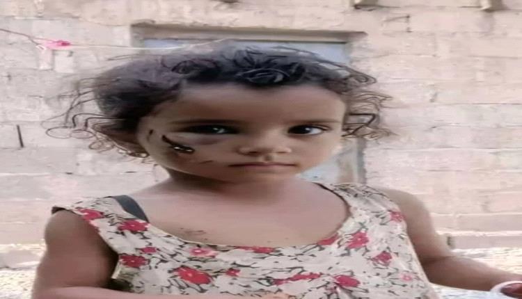 وفاة الطفلة خديجة بعد أيام من تعرضها لعضة كلب مسعور في تعز