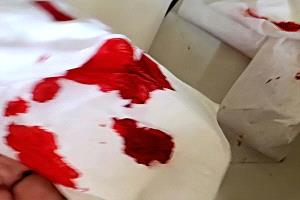 طبيب يكشف سبب نزيف معدة فتاة في صنعاء.. المسكنات العشوائية وراء تآكلات المعدة والمريء