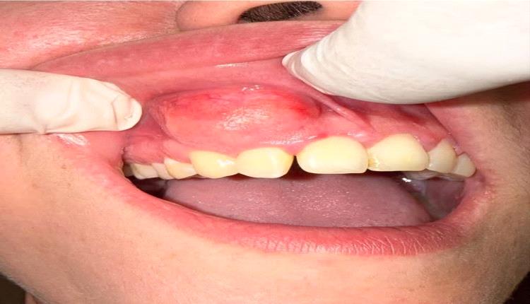 الصيام المتقطع قد يساعد في علاج أمراض اللثة
