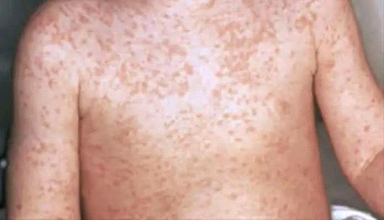 صحة مأرب: الحصبة تغزو المحافظة وتسجيل 1.5 ألف إصابة و10 وفيات 