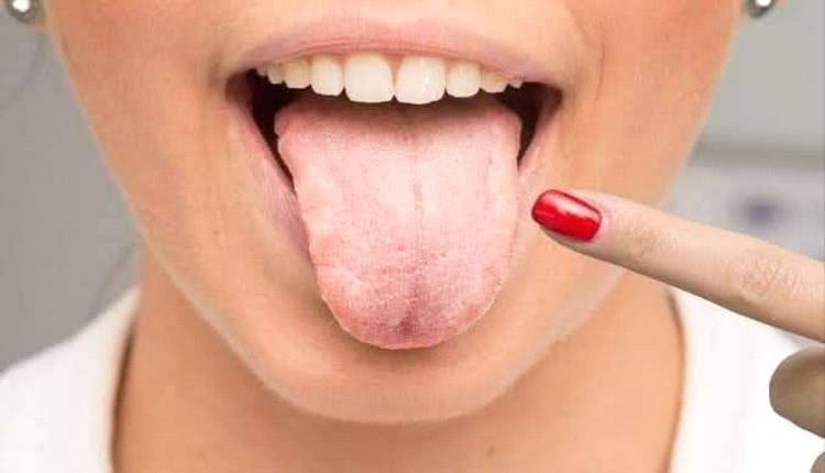 تغيرات في اللسان قد تشير إلى الإصابة بالسرطان