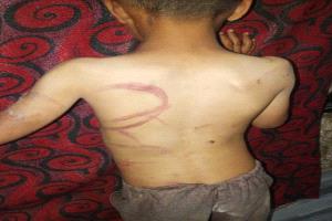اعتداء وحشي يهز تعز.. أب يعذب طفله بالضرب ويترك إصابات بالغة في جسده