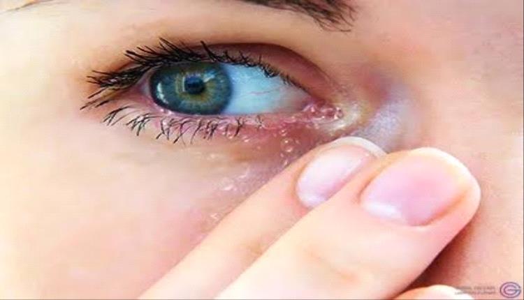 نصائح مهمة للوقاية من جفاف وزغللة العين خلال الصيام  