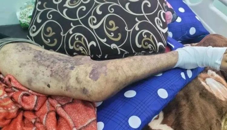 نداء استغاثة من سجين يعاني من مرض نادر في تعز: أفرجوا عني قبل فوات الأوان