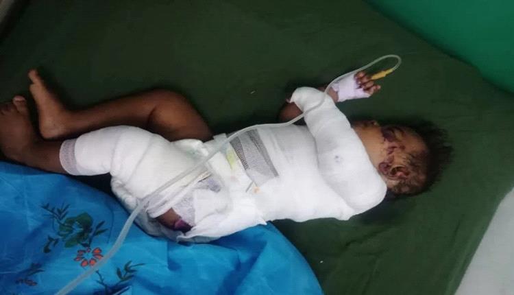 إصابة طفلين في حريق بمنزل في الحديدة 