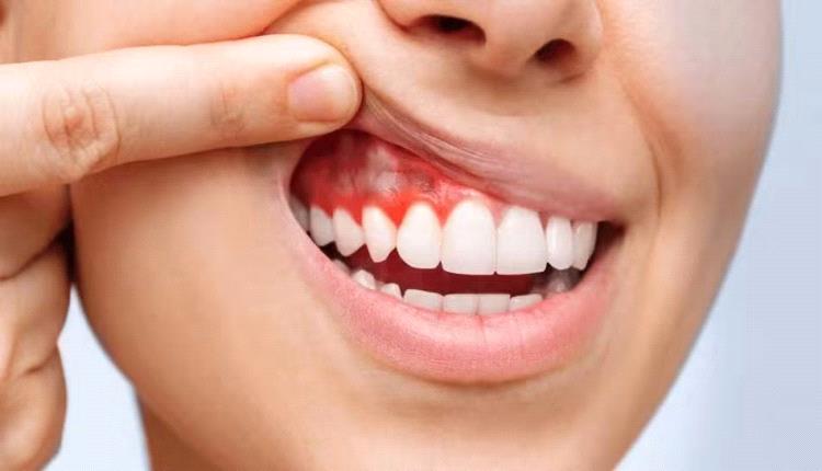 هذه الأطعمة تقلل خطر أمراض اللثة والأسنان.. تعرف عليها
