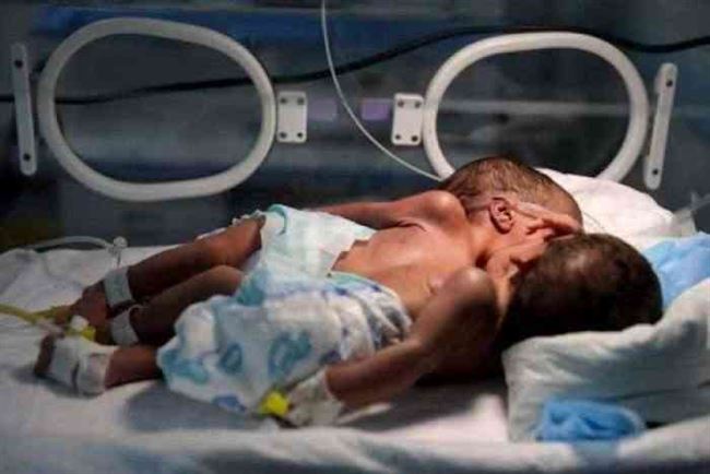 التوأم السيامي يتوجه بطائرة أممية إلى عمان