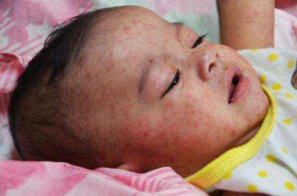إعلان أممي بتفشي الحصبة وشلل الأطفال في اليمن