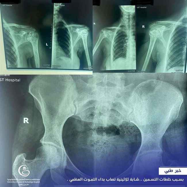 مرض خطير وغريب يضرب شابة في صنعاء بعد استخدامها علاج خاص بالوزن لمدة طويلة.. مروع