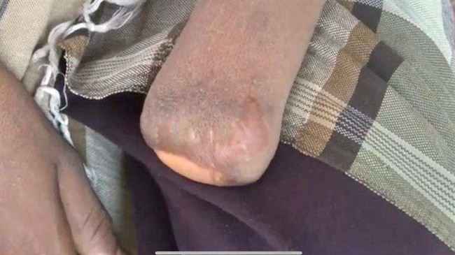 الأمم المتحدة تكشف حصيلة جديدة لضحايا موت الحوثي المدفون