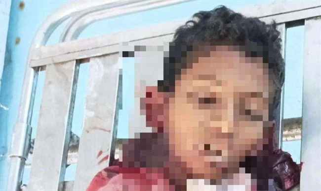 رجوم الحوثية تمزق جسد الطفل جهاد من الجو أثناء عمله بجمع قوارير فارغة بحيس