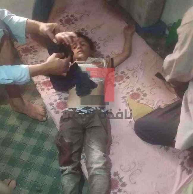 شاهد.. الحوثي يمطر قرية سكنية بمختلف الأسلحة ويمزق يد طفل في ربيعه الخامس