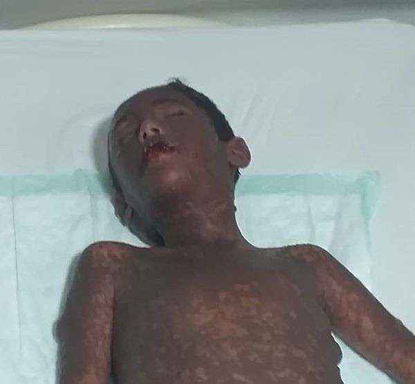 خطير ومرعب.. هكذا تحول جسد طفل تعرض لإشعاع صاروخ حوثي وظهور أعراض غريبة حيرت الأطباء