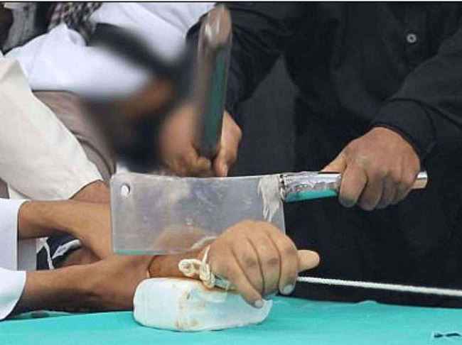 أول محافظة يمنية تعيد تطبيق حكم قطع يد السارق .. قطع اليد اليمني لثلاثة متهمين في يافع