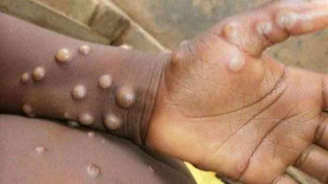 تحسباً لوباء جدري القرود .. الصحة اليمنية تعلن رفع الجاهزية